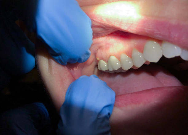 Best Emergency Dentist for Knocked-Out Tooth in Saline, MI