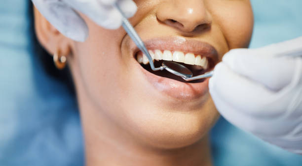 Best Emergency Dentist for Lost Fillings or Crowns in Saline, MI