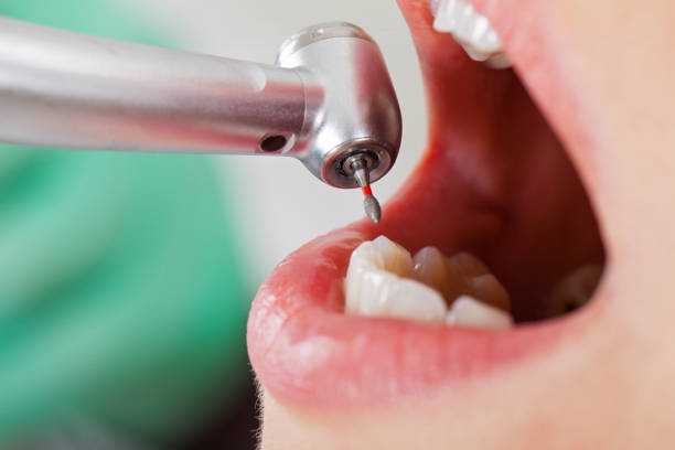 Best Broken or Cracked Tooth Emergency Dentist in Saline, MI